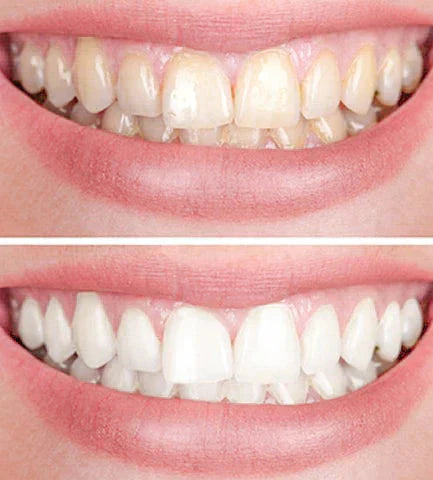 Smiley bělicí pero na zuby – zářivý úsměv na cestách