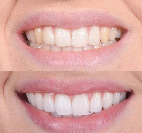 Smiley bělicí pero na zuby – zářivý úsměv na cestách
