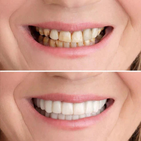 RadianceWrap - Cosmetic Smile Cover