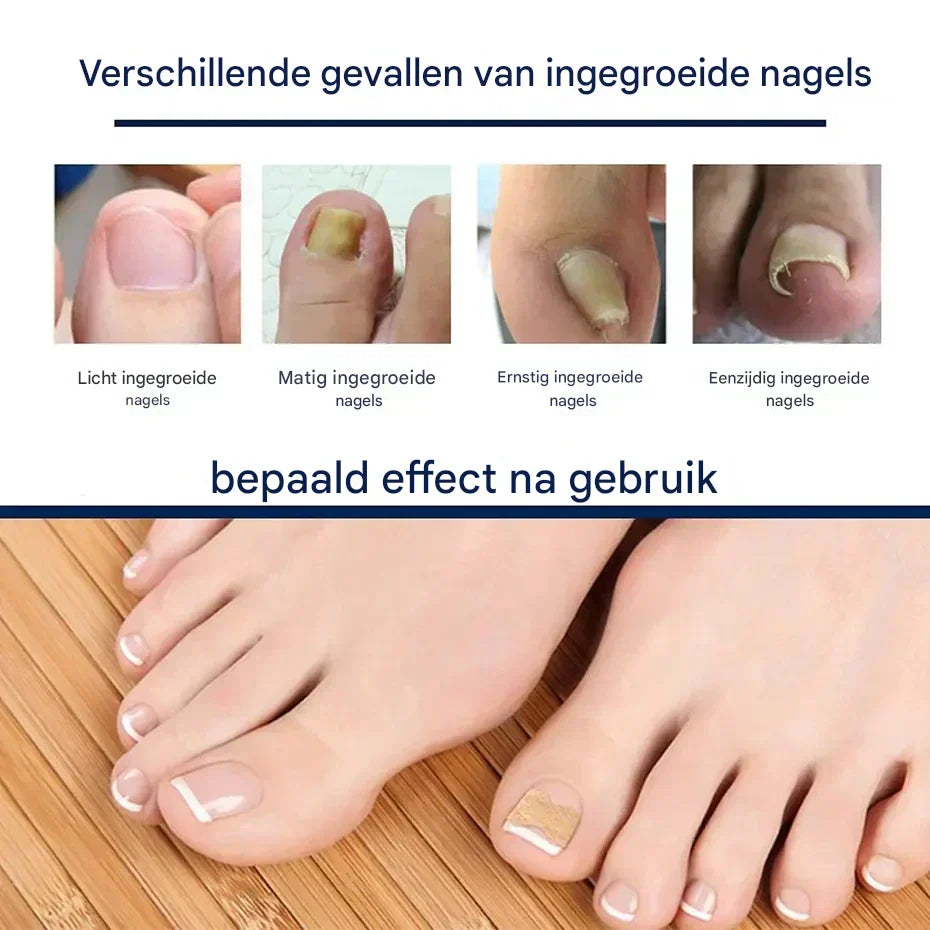 NailEase – náplasti na péči o nehty