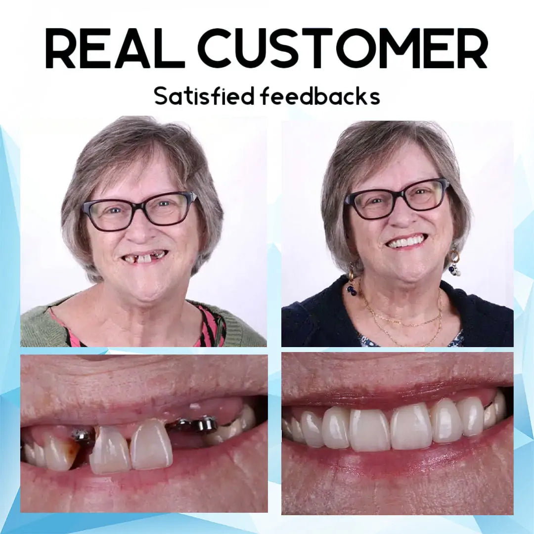 SmilePro - Temporary Cosmetic Teeth Cover Set